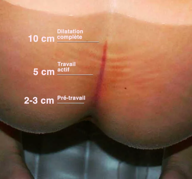 Cette précieuse ligne pourpre pendant l'accouchement peut indiquer votre dilatation (sans toucher vaginal !)