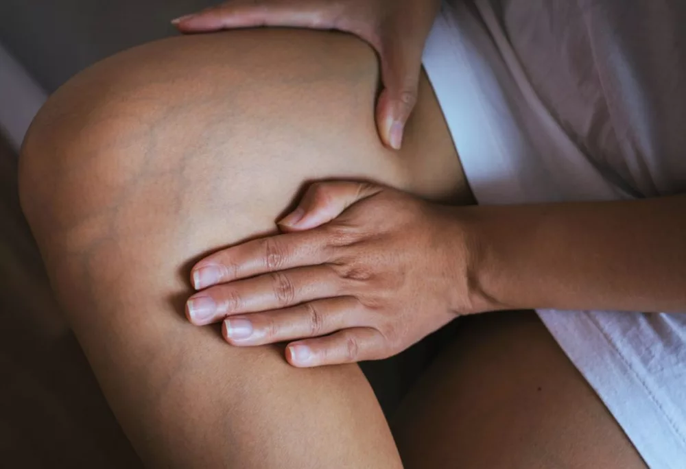 les meilleurs remèdes naturels en cas de varice vulvaire pendant la grossesse sur Naturelle maman