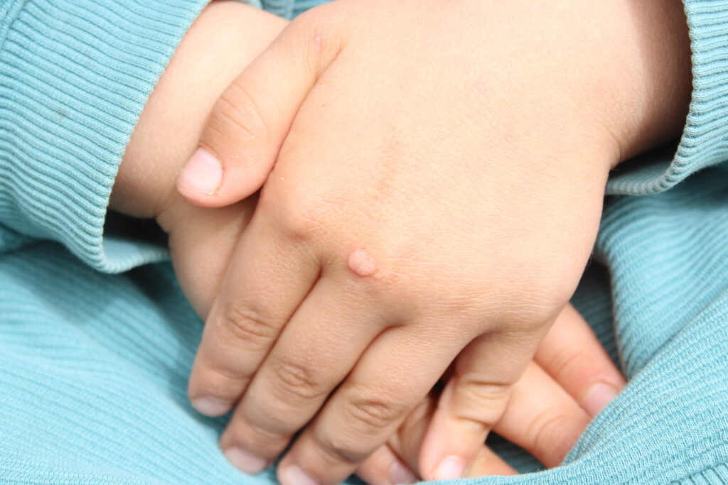 Mes trois meilleurs remèdes naturels contre les verrues sur Naturelle Maman