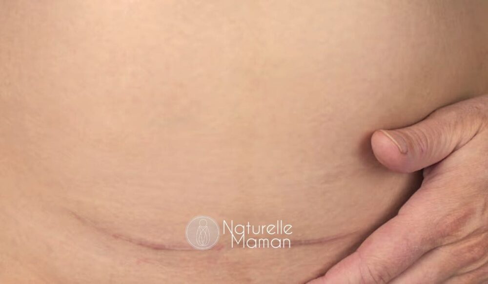 Consultation avec une sage-femme pour planifier une grossesse en toute sécurité après une césarienne - Naturelle Maman