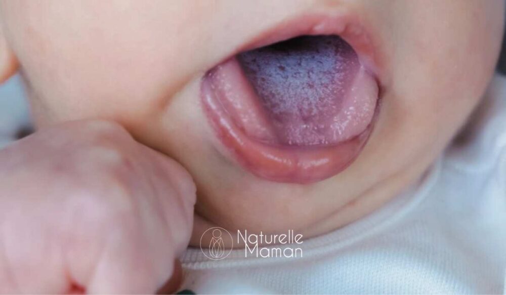 Bébé qui tire la langue avec du muguet, mycose buccale courante chez les nourrissons - Naturelle maman