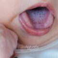 Bébé qui tire la langue avec du muguet, mycose buccale courante chez les nourrissons - Naturelle maman